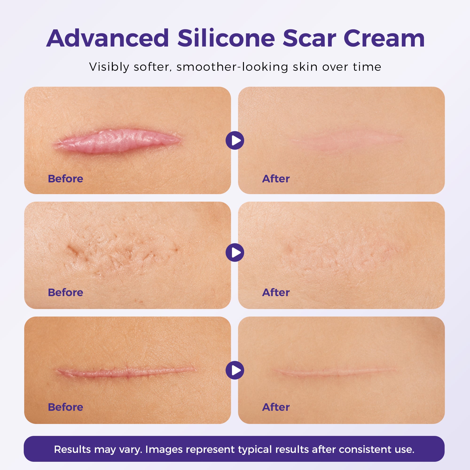Advanced Silicone Scar Cream before and after — visibly softer, smoother-looking skin over time