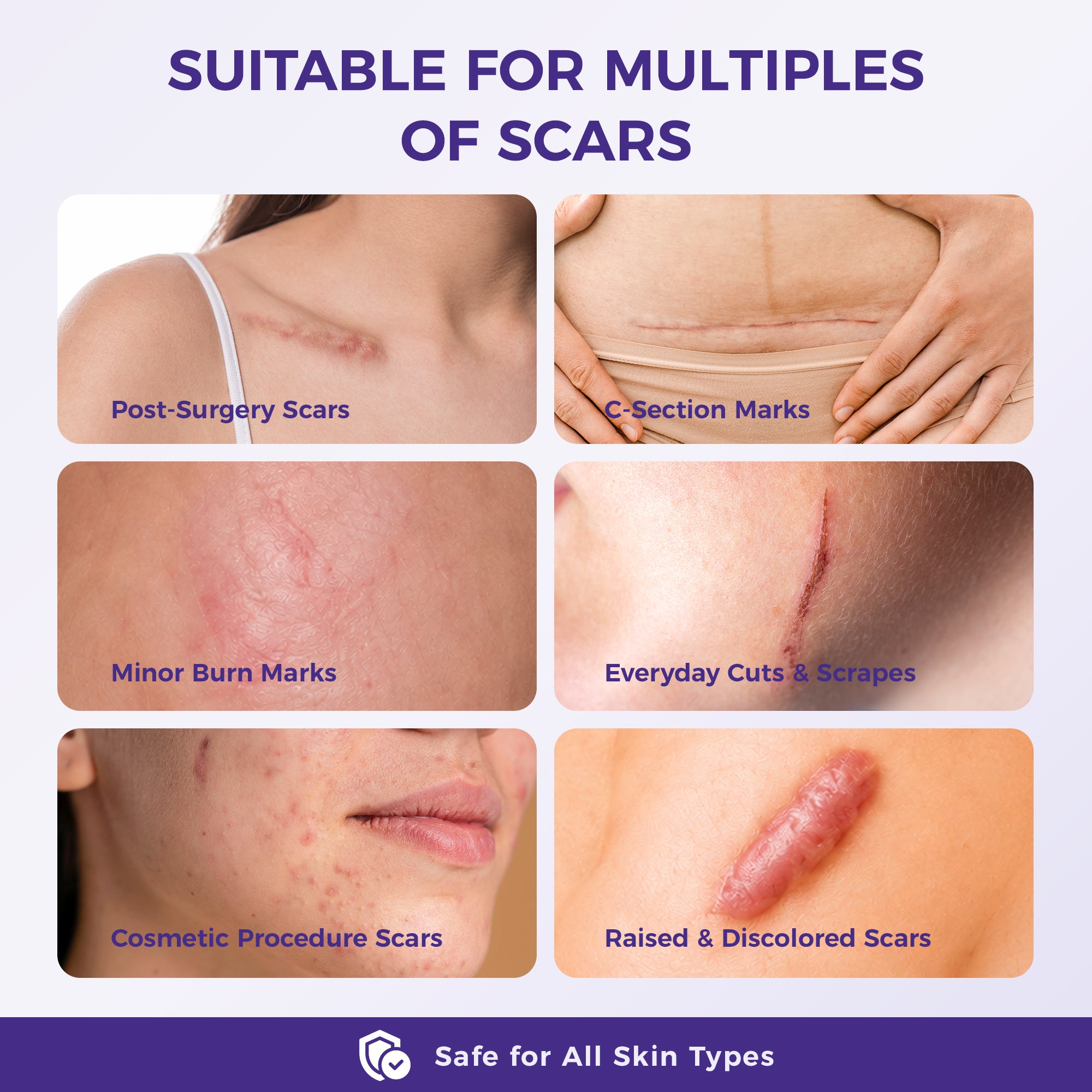 Suitable for many types of scars and safe for all skin types